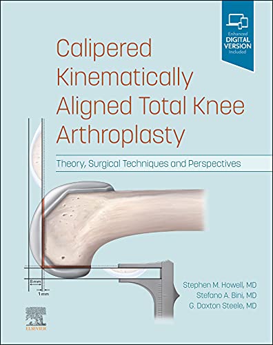 Calipered Kinematically aligned Total Knee Arthroplasty ⋆ eMEDICAL BOOKS